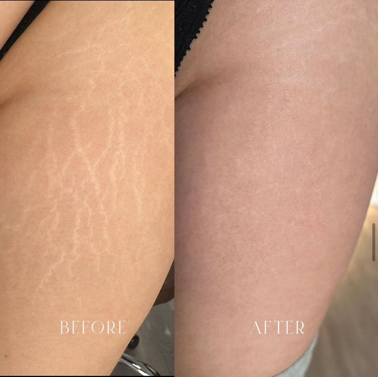 Stretch Mark Camouflage