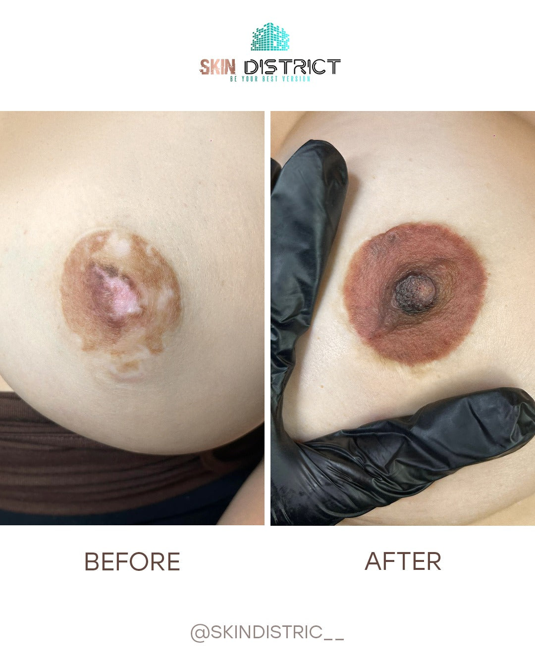areola reconstruction