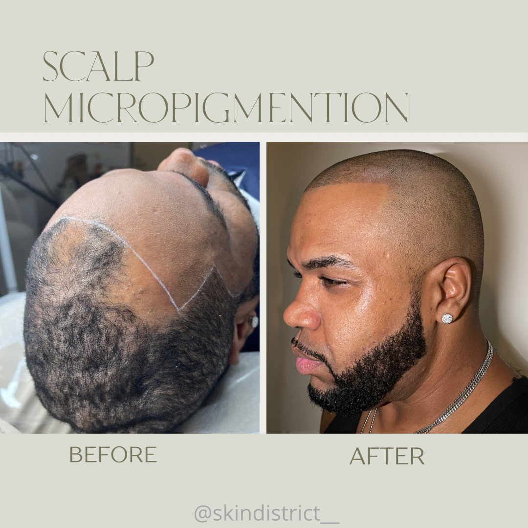 Hair Micropigmentation - Scalp