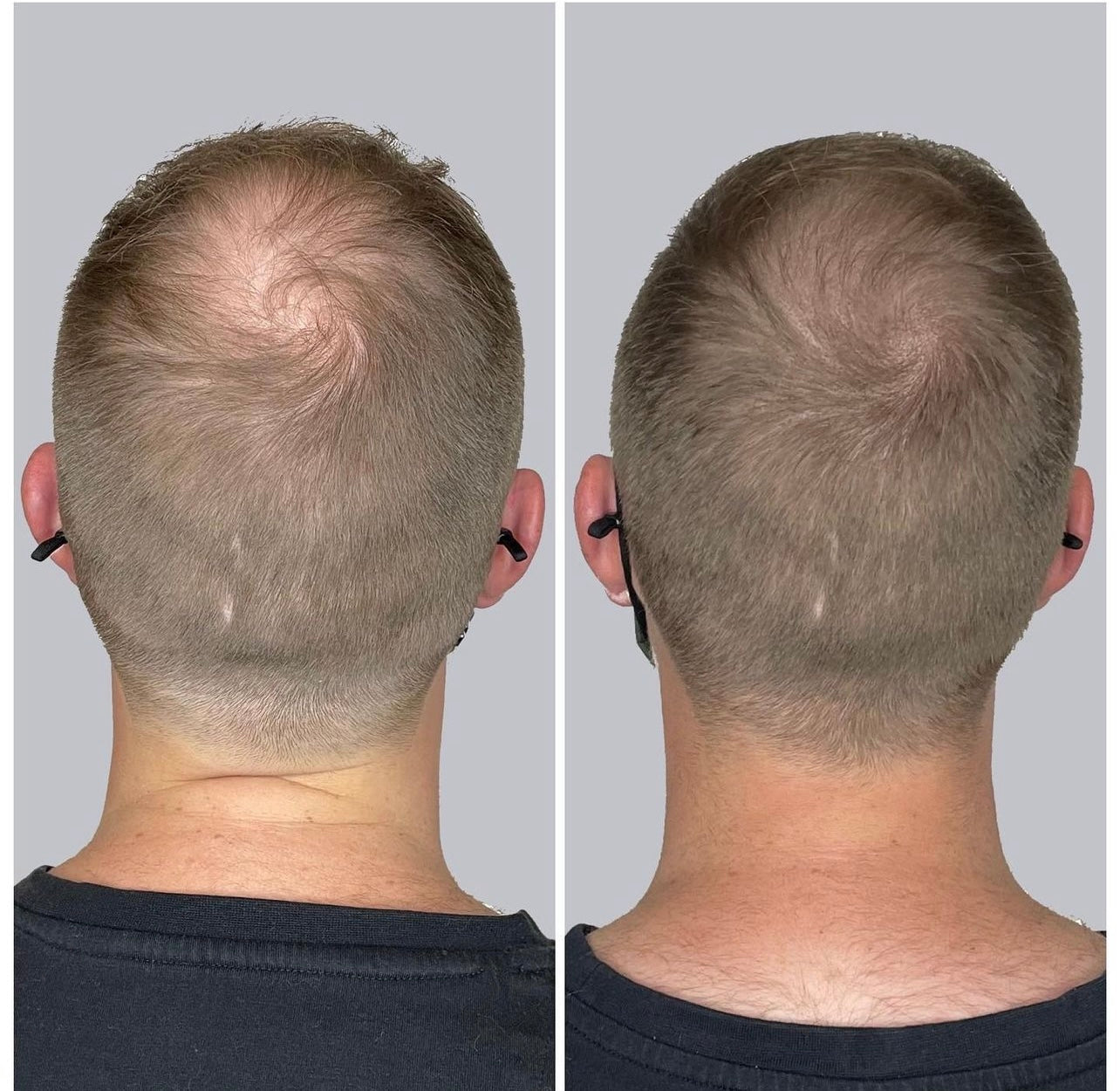 Hair Micropigmentation - Scalp