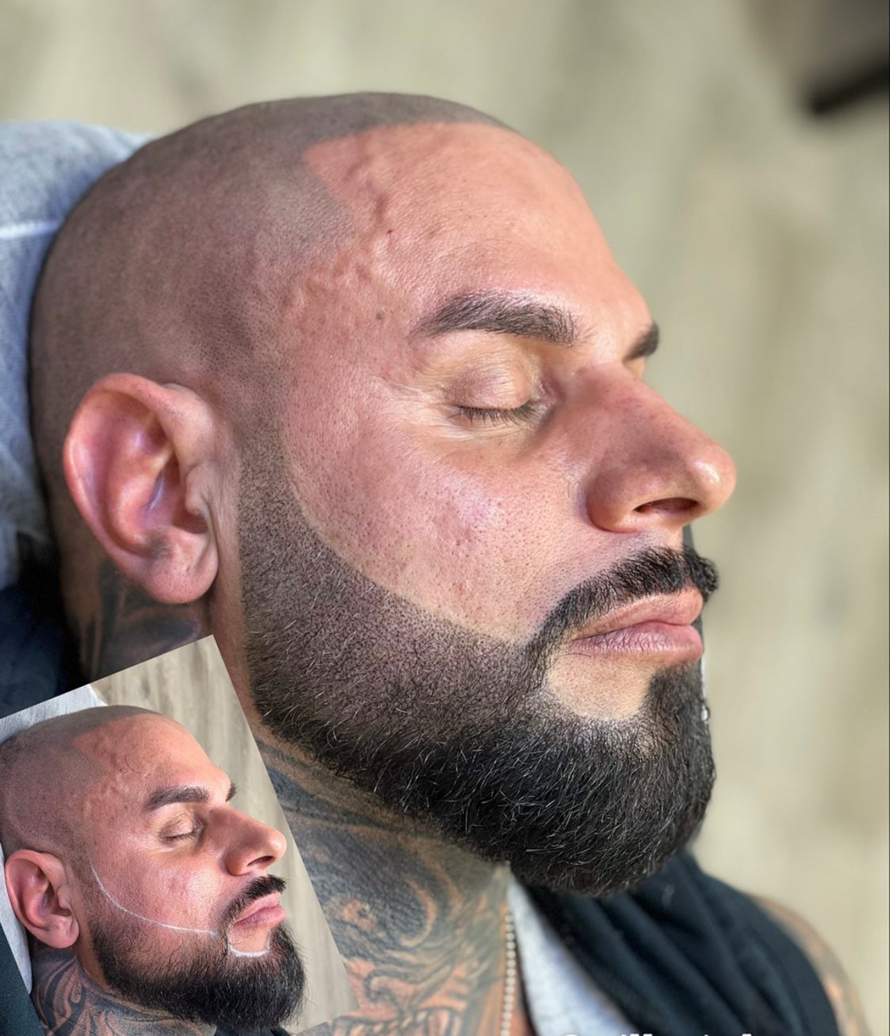 Scalp Micropigmentation Beard