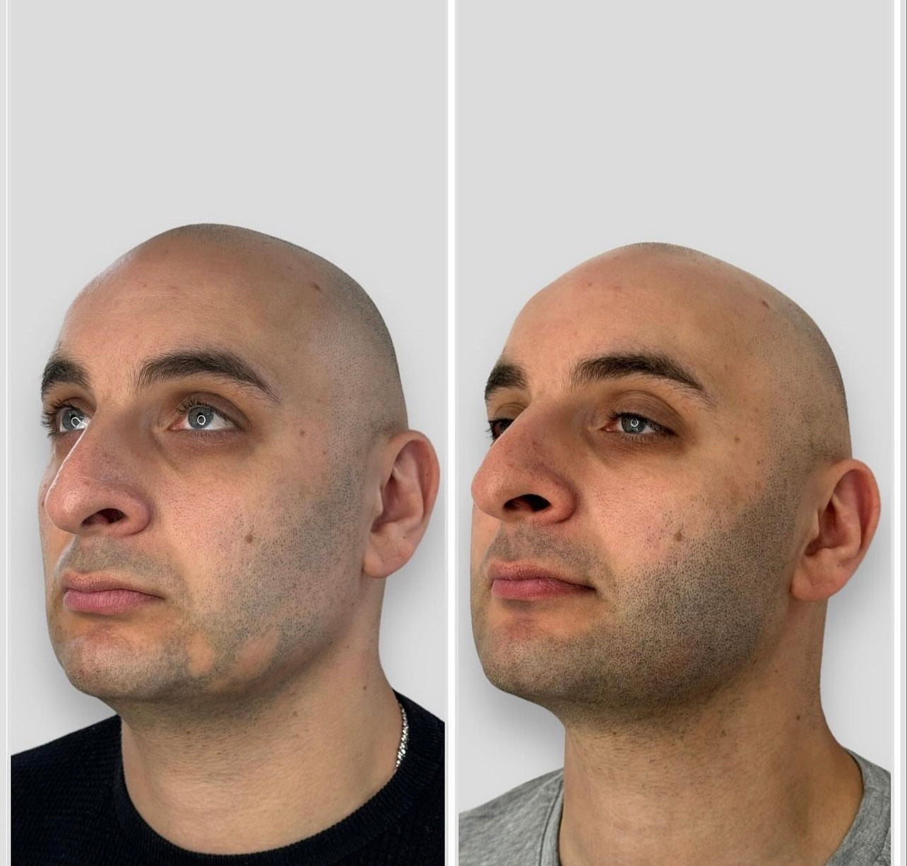 Scalp Micropigmentation Beard