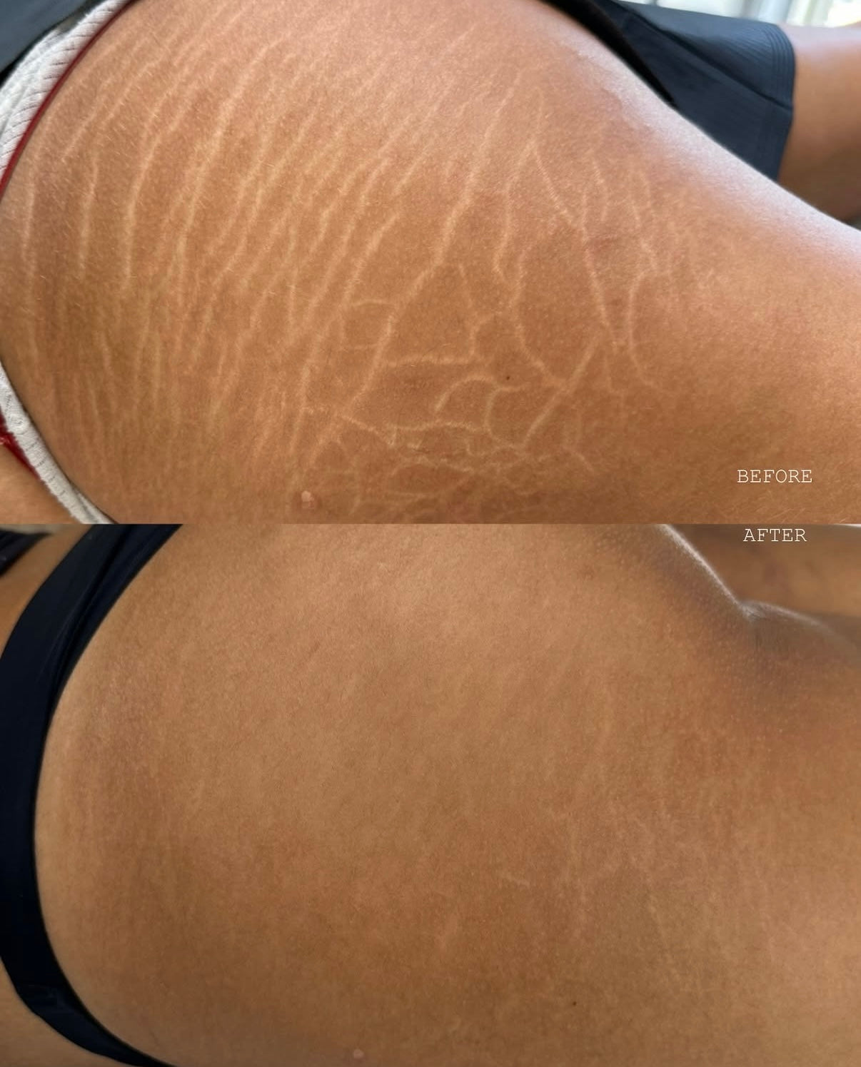 Stretch Mark Camouflage