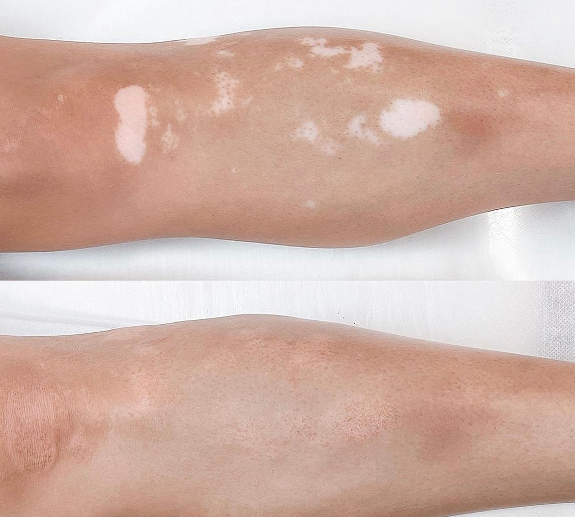 Vitiligo Micropigmentation