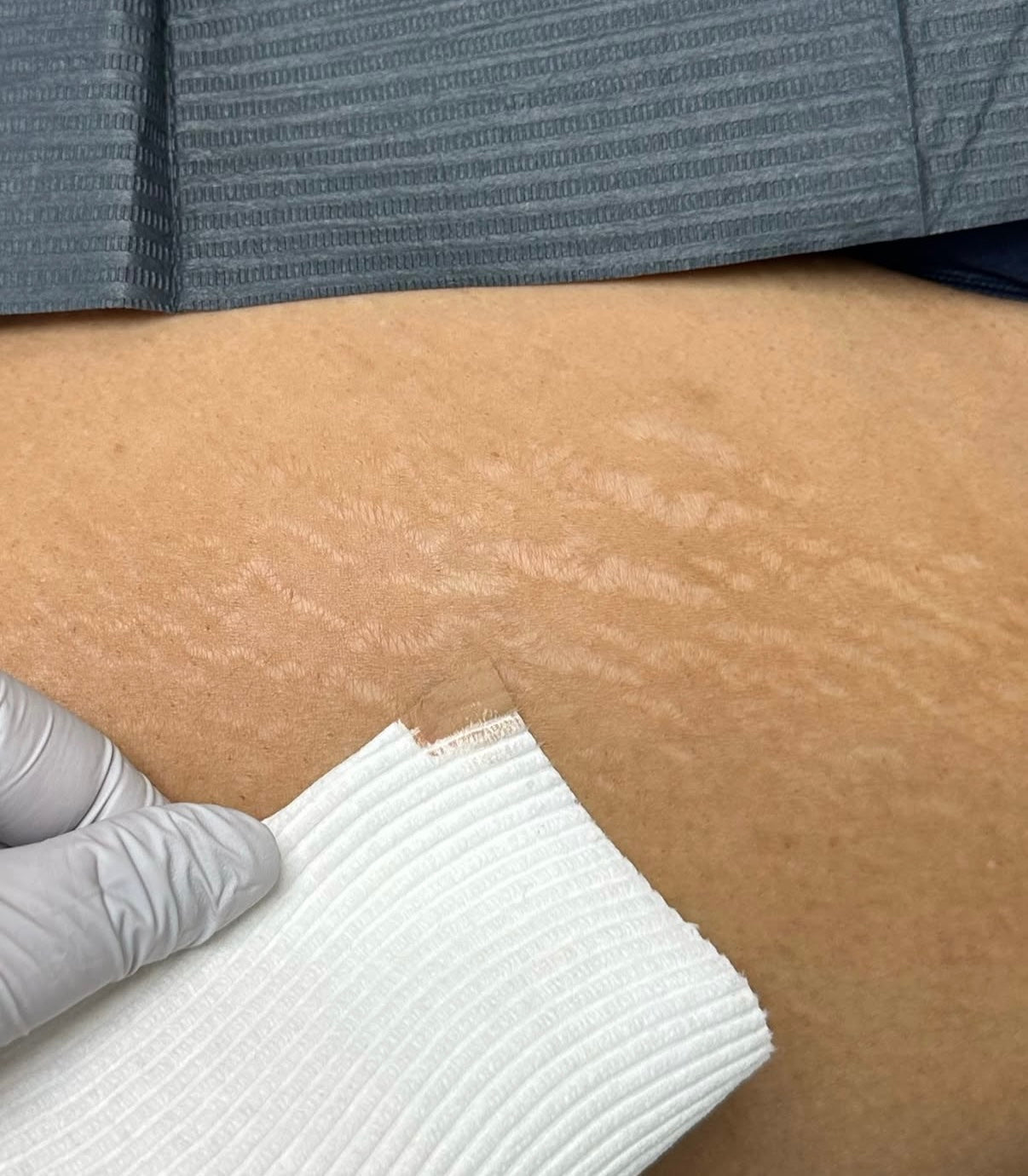 Stretch Mark Camouflage