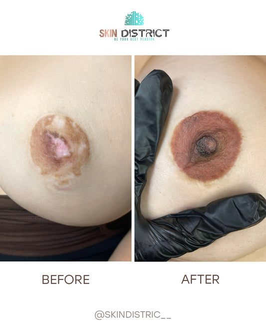 areola reconstruction