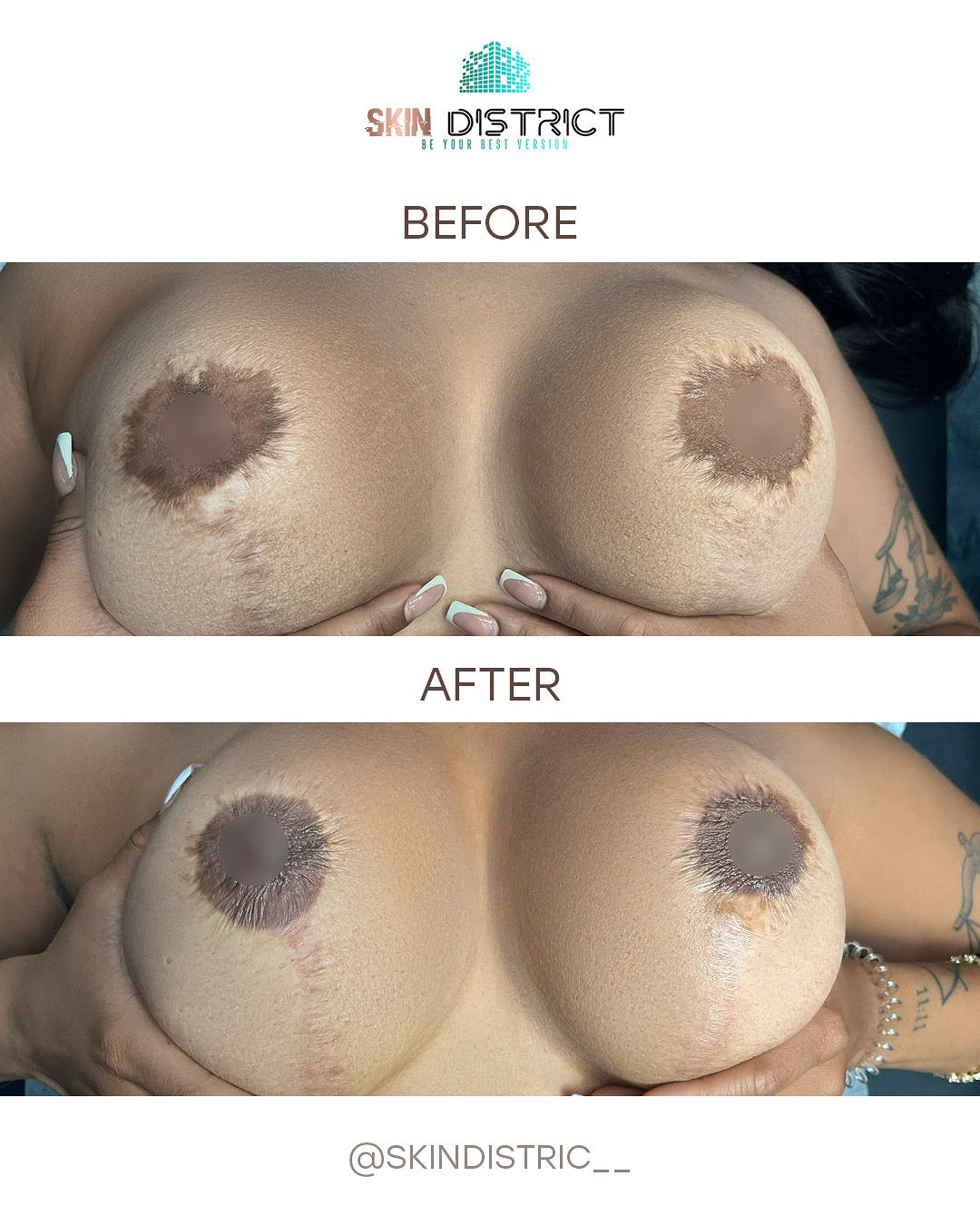 areola reconstruction