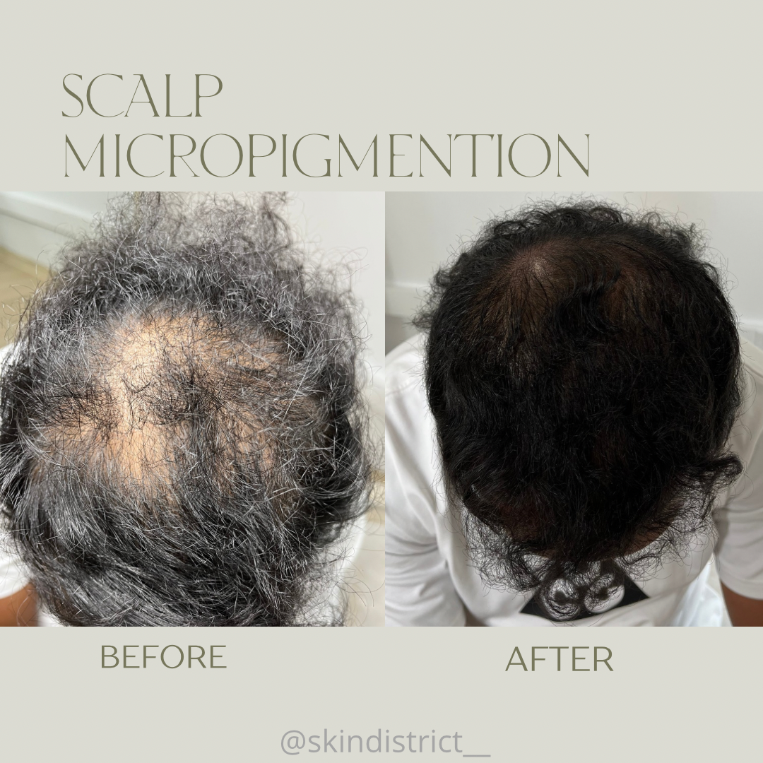 Hair Micropigmentation - Scalp